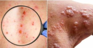 Waspadai Penyakit Mpox, Ini Imbauan Dinkes Pesawaran
